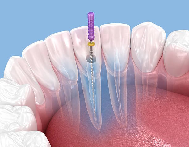 SINGLE SITTING ROOT CANAL AT FORTDENTAL TOLICHOWKI
