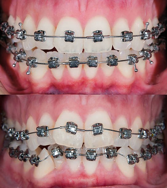 ORTHODONTICS AT FORT DENTAL TOLICHWOKI