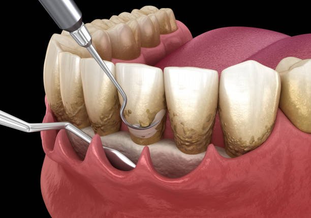 Scaling And Root Planing AT FORT DENTAL TOLICHOWKI