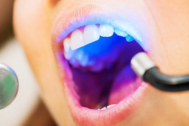 laser assisted flap surgery at fort dental tolichowki