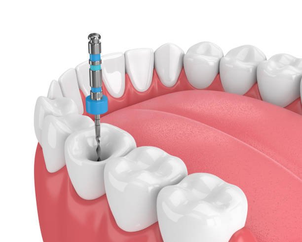 SINGLE SITTING ROOT CANAL AT FORTDENTAL TOLICHOWKI