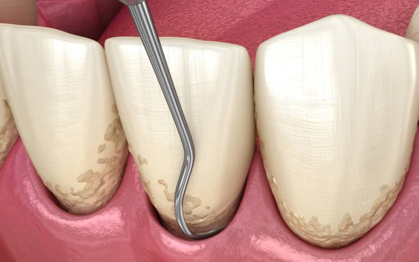 Scaling And Root Planing AT FORT DENTAL TOLICHOWKI