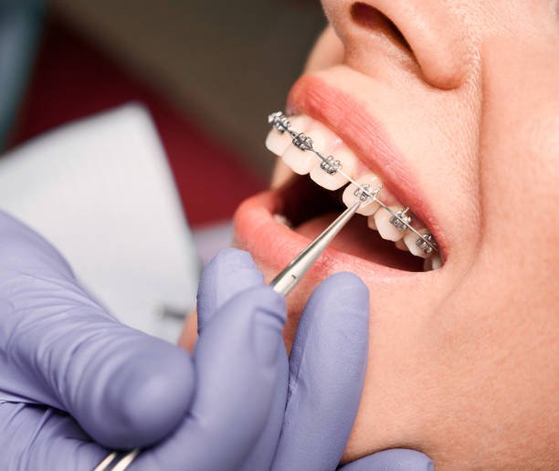 ORTHODONTICS AT FORT DENTAL TOLICHOWKI
